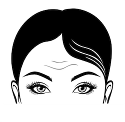 Forehead ThreadLift - Glabella Lift Toronto & Mississauga